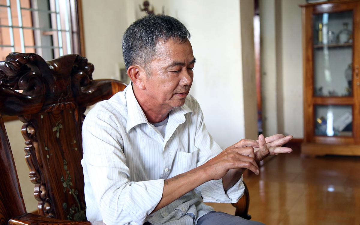 Bàn tay của ông Quý bị mất ngón, đứt gân, không thể co duỗi được bình thường.