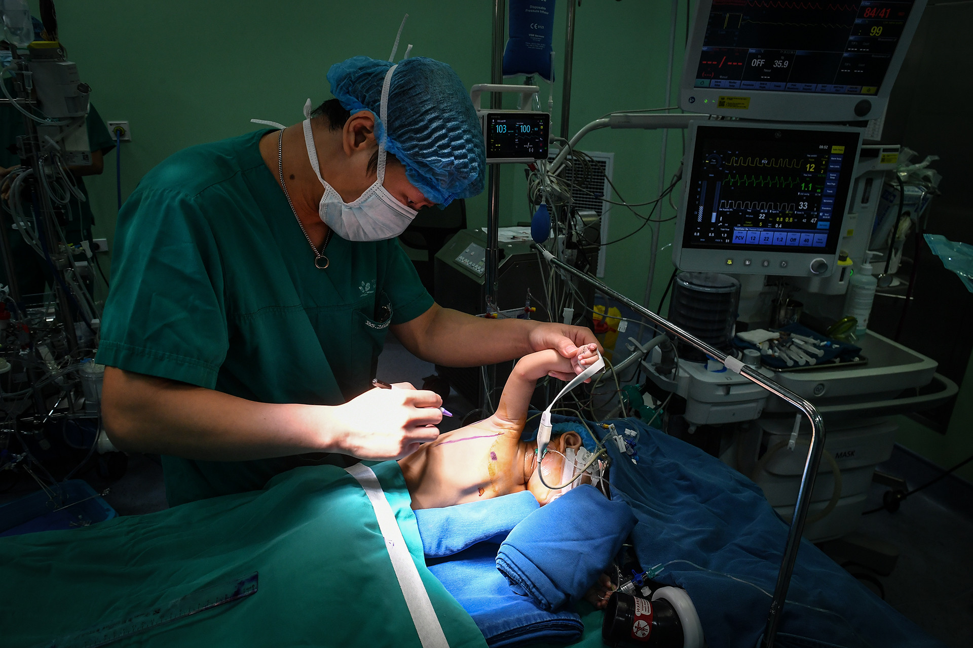 [Ảnh] Cận cảnh ca mổ thứ 700 trường hợp tim bẩm sinh với kỹ thuật ít xâm lấn ảnh 5