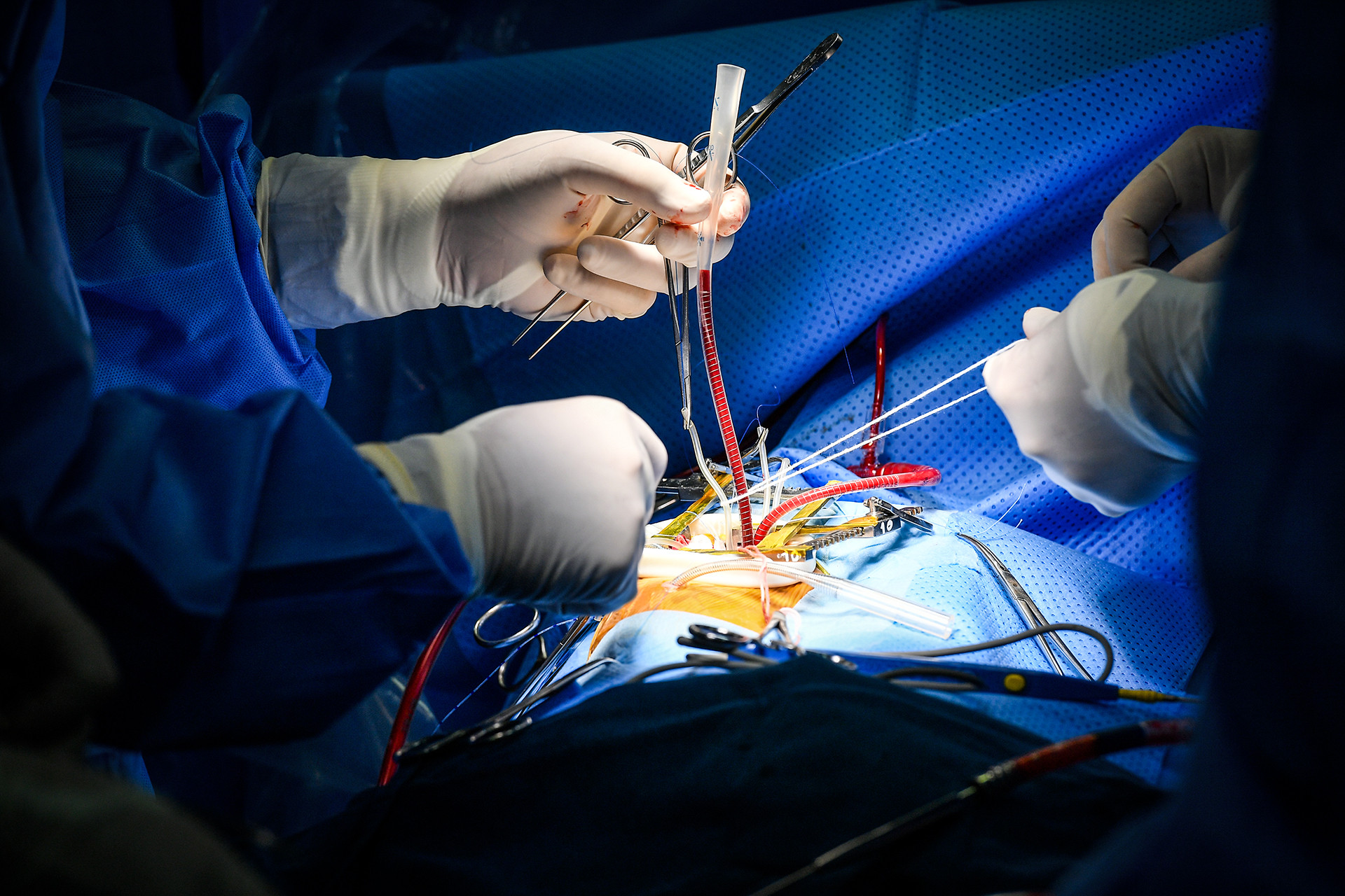 [Ảnh] Cận cảnh ca mổ thứ 700 trường hợp tim bẩm sinh với kỹ thuật ít xâm lấn ảnh 16