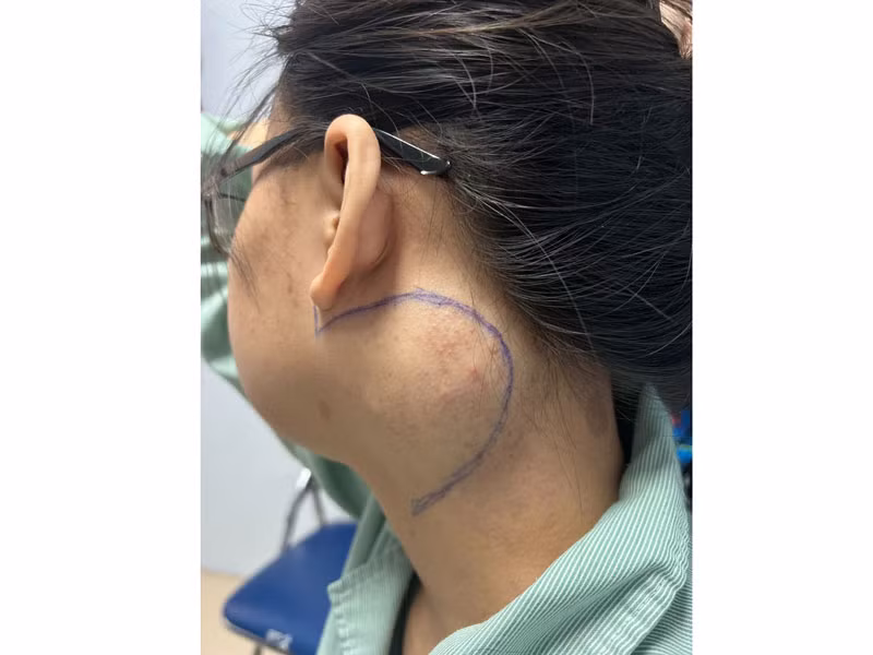 Vị trí khối u của người bệnh trước khi được các bác sĩ thực hiện ca phẫu thuật.