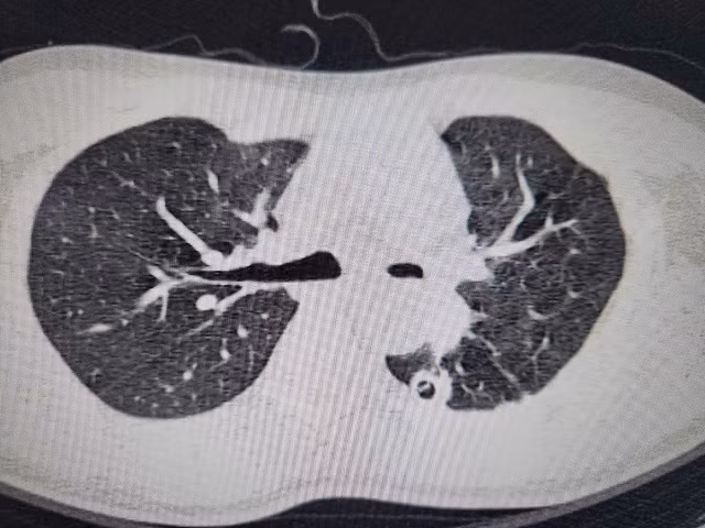 Hình ảnh phim chụp hẹp phế quản gốc trái, xẹp hoàn toàn phổi trái do di chứng của lao phổi.