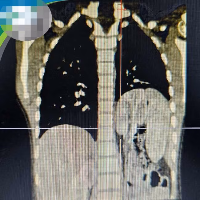 Hình ảnh chụp thoát vị hoành trái bẩm sinh với tạng thoát vị là lách, ruột non, đại tràng và kèm theo thận lạc chỗ trên lồng ngực của trẻ.