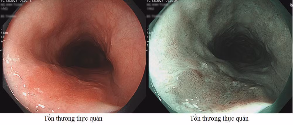 Hình ảnh nội soi thông thường (bên trái) và công nghệ nội soi NBI phóng đại, tổn thương quan sát được có cấu trúc mạch máu biến đổi type B1, nghi ngờ ác tính (bên phải).