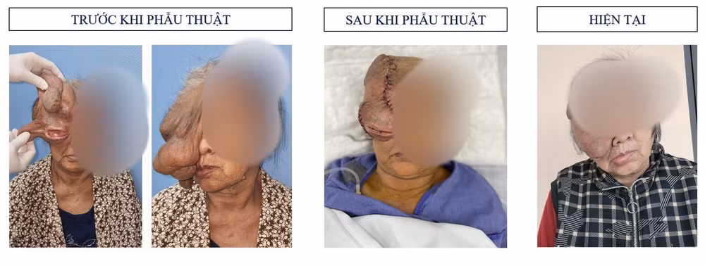 Trường hợp đặc biệt đã được tái tạo gương mặt mới sau phẫu thuật. (Ảnh: Bệnh viện cung cấp)