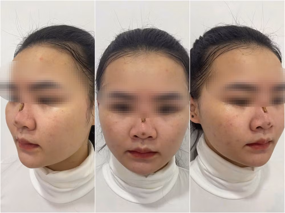 Biến chứng sau căng chỉ nâng mũi.