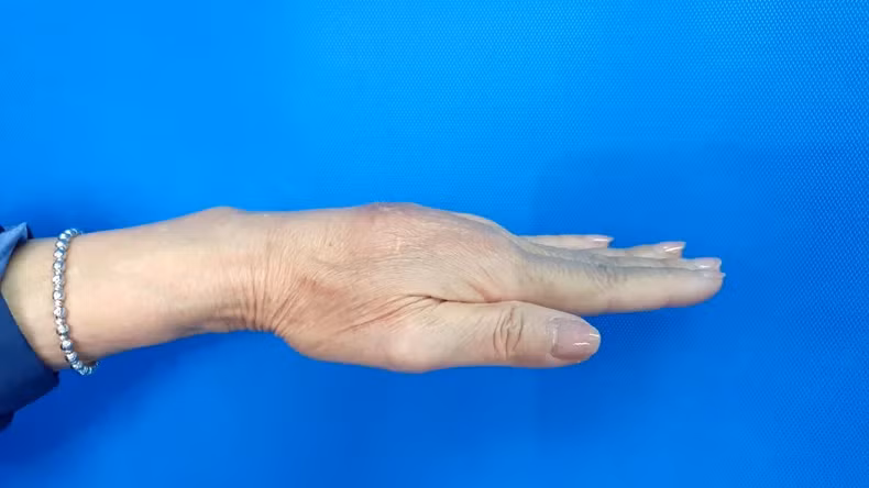 Bàn tay bị biến chứng u hạt sau khi tiêm filler tay.