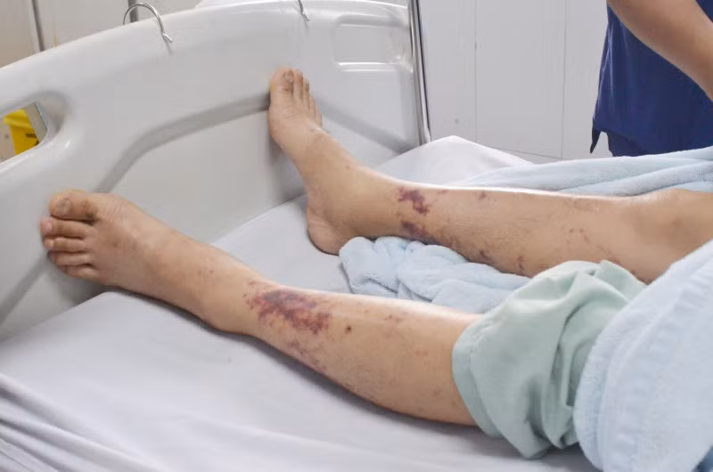 Vết xuất huyết dưới da rải rác sau 3 ngày nam bệnh nhân tại Hạ Long, Quảng Ninh mua và chế biến thịt lợn. Vết xuất huyết dưới da rải rác sau 3 ngày nam bệnh nhân tại Hạ Long, Quảng Ninh mua và chế biến thịt lợn.