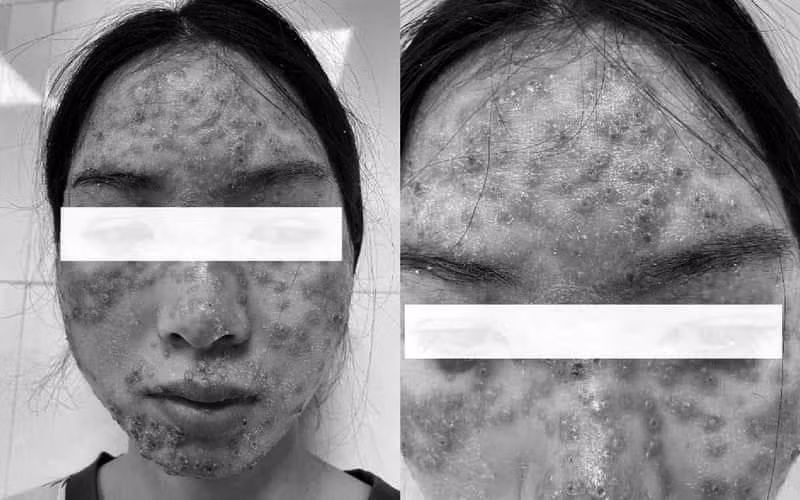 Tổn thương của người bệnh. (Ảnh: BVCC)