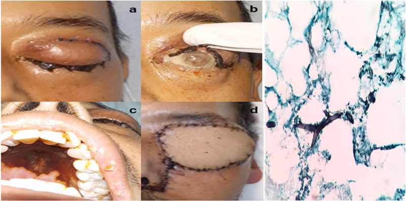 Một số hình ảnh tổn thương của bệnh nấm đen và hình ảnh sợi nấm đen. (Ảnh minh họa)