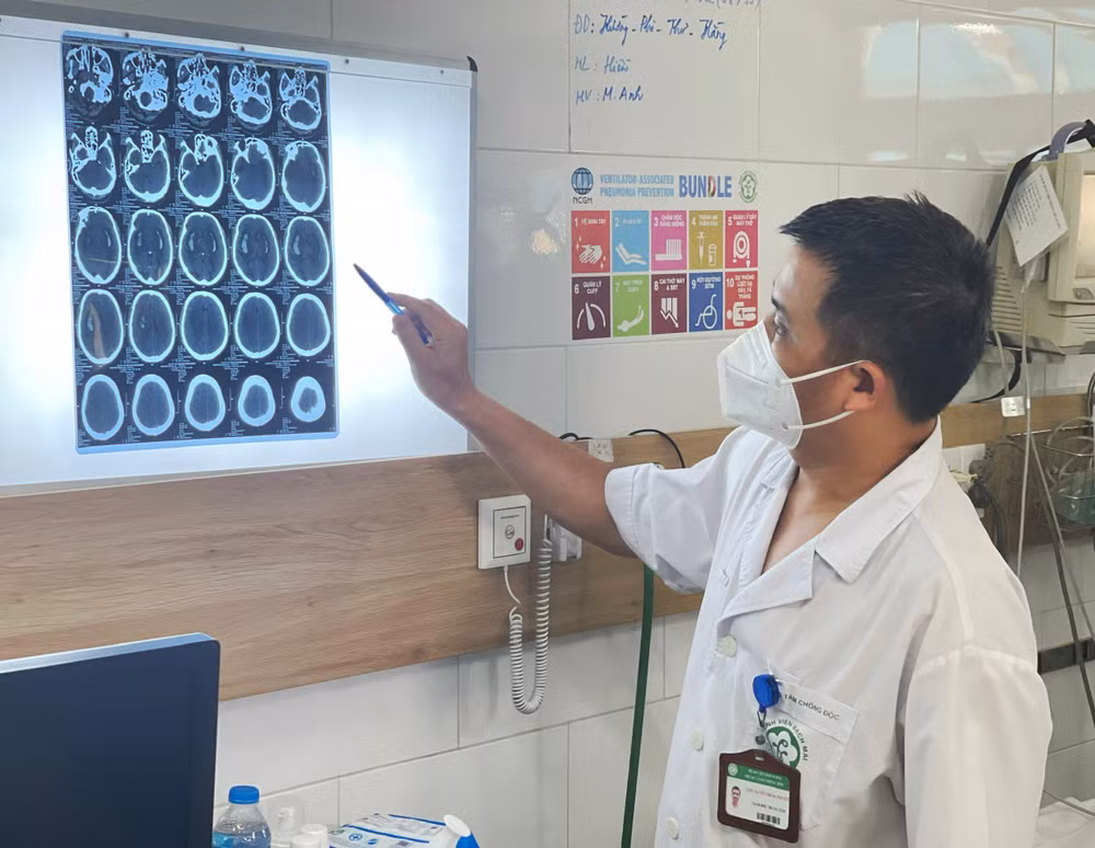 TS Nguyễn Trung Nguyên, Giám đốc Trung tâm Chống độc (Bệnh viện Bạch Mai) cho biết người ngộ độc rượu methanol sẽ có nguy cơ tổn thương não.