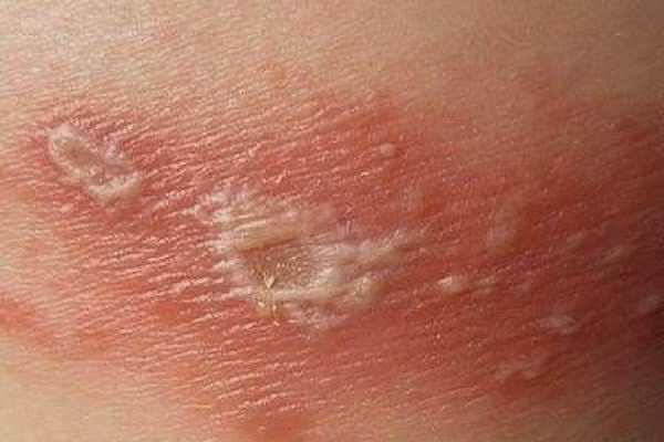 Tổn thương da do tiếp xúc kiến ba khoang. Tổn thương da do tiếp xúc kiến ba khoang.