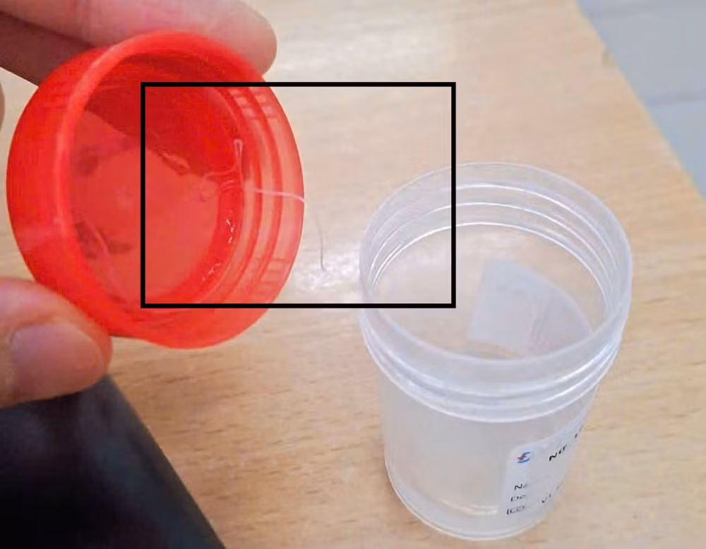 Hình ảnh ký sinh trùng được lấy ra từ mắt bệnh nhân, đang được phân tích tại phòng xét nghiệm ký sinh trùng học.