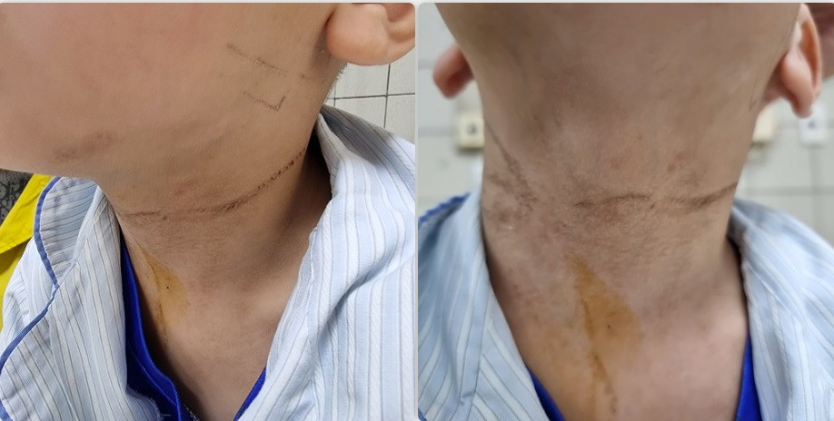 Hình ảnh vết dây thắt ở cổ bệnh nhi. Hình ảnh vết dây thắt ở cổ bệnh nhi.