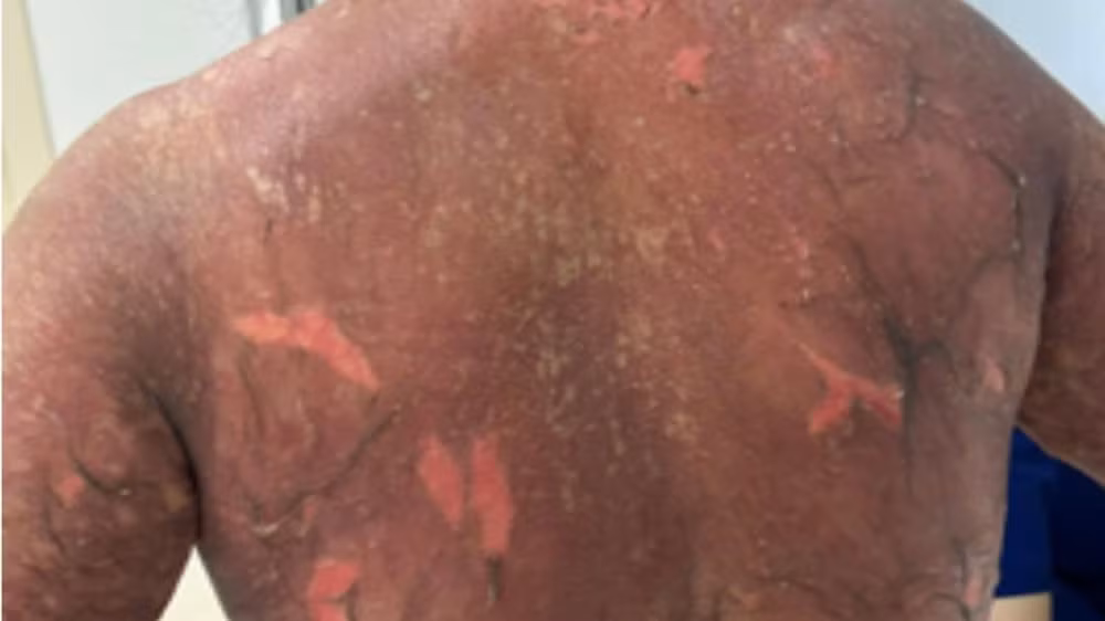 Trường hợp biến chứng nặng do dùng thuốc đông y không rõ nguồn gốc. 