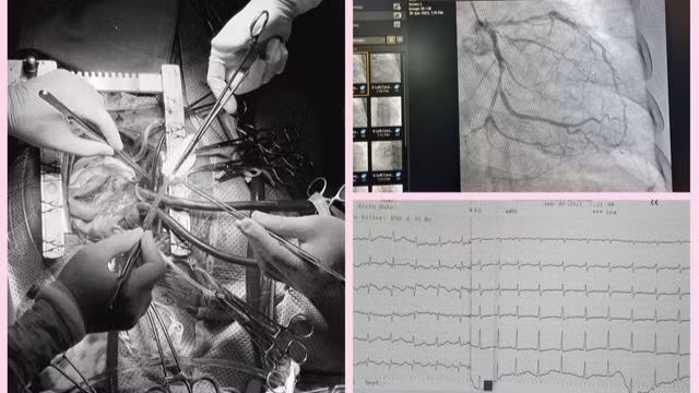 Nhồi máu cơ tim gây biến chứng thủng vách liên thất
