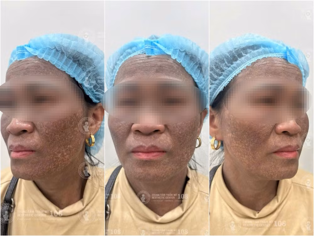 Bệnh nhân tổn thương sắc tố da nghiêm trọng.