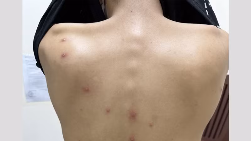 Tính đến nay, Thành phố Hồ Chí Minh đã ghi nhận 4 ca bệnh đậu mùa khỉ trong tổng số 5 trường hợp của cả nước.