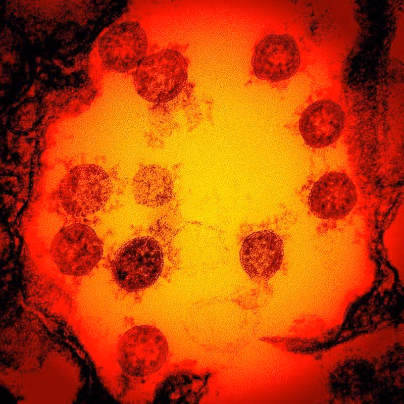 Ảnh vi điện tử được tăng cường màu chụp lại các hạt virus SARS-CoV-2 được phân lập từ mẫu bệnh phẩm của 1 bệnh nhân. (Ảnh: Viện Dị ứng và bệnh truyền nhiễm quốc gia Mỹ)