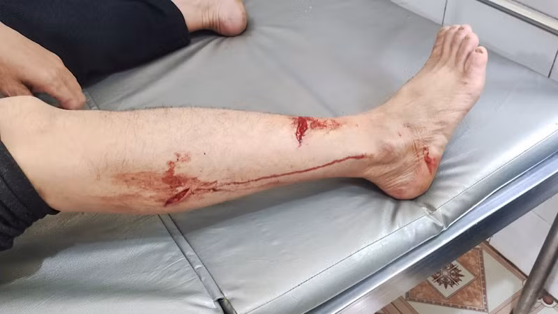Ông Đinh Như Quý bị voọc cắn rách chân phải khâu 6 mũi. 