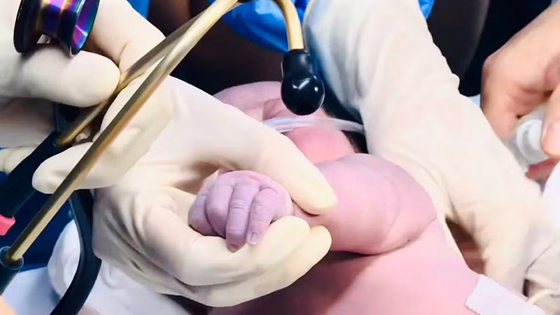 Một lần nữa cứu sống thành công một trường hợp bé bị bệnh tim block nhĩ thất độ 3 do mẹ có bệnh lý Lupus. (Ảnh bệnh viện cung cấp).