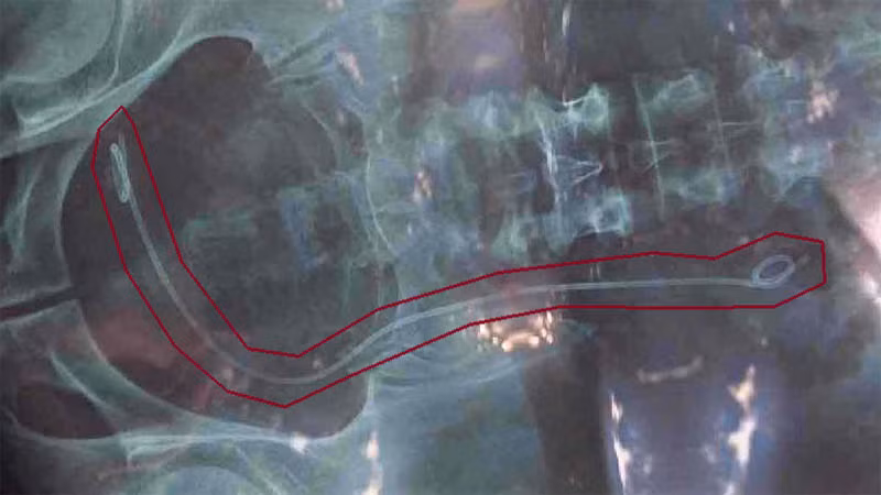 Kết quả X-quang của bệnh nhân H. bị nhầm lẫn với bệnh nhân khác.