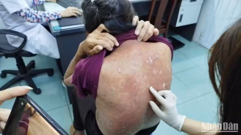 Bệnh viện Da liễu Thái Bình (cơ sở 2) tại đang dôi dư nhân viên chăm sóc, phục vụ bệnh nhân phong.