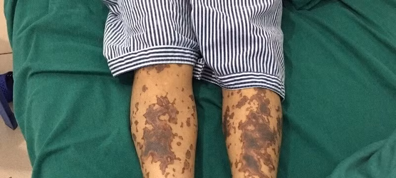 Một bệnh nhân mắc bệnh Liên câu lợn đang được điều trị tại bệnh viện. (Ảnh minh họa)