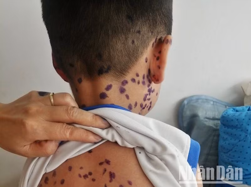 Khi phát hiện trẻ mắc bệnh thủy đậu cần cho trẻ ở nhà để điều trị và tránh lây lan cho các cháu chung quanh.