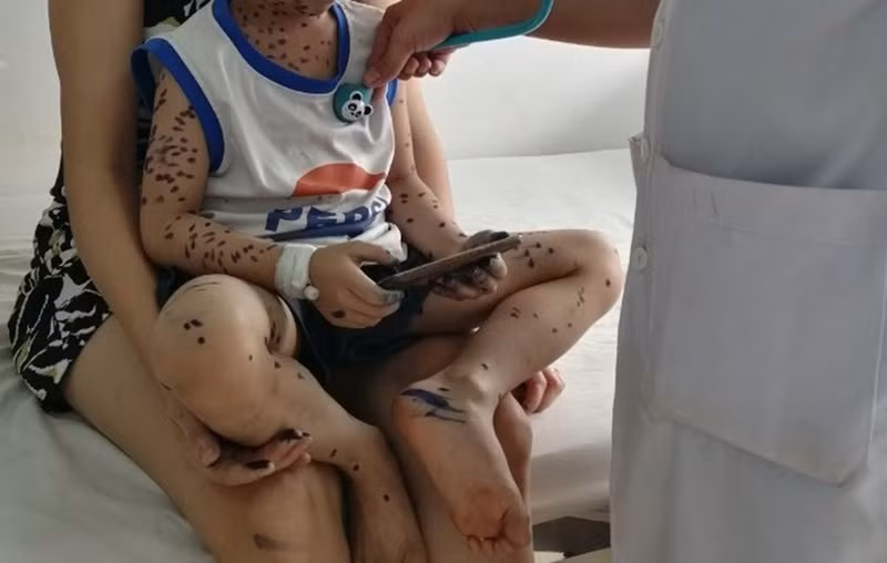 Nếu không phòng, chống dịch đúng cách, dịch thủy đậu sẽ lây lan nhanh trong cộng đồng. 