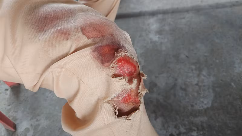 Quá trình truy bắt 3 đối tượng, 1 đồng chí Cảnh sát giao thông tỉnh Đồng Tháp bị xây xát ở chân. (Ảnh: Công an cung cấp)