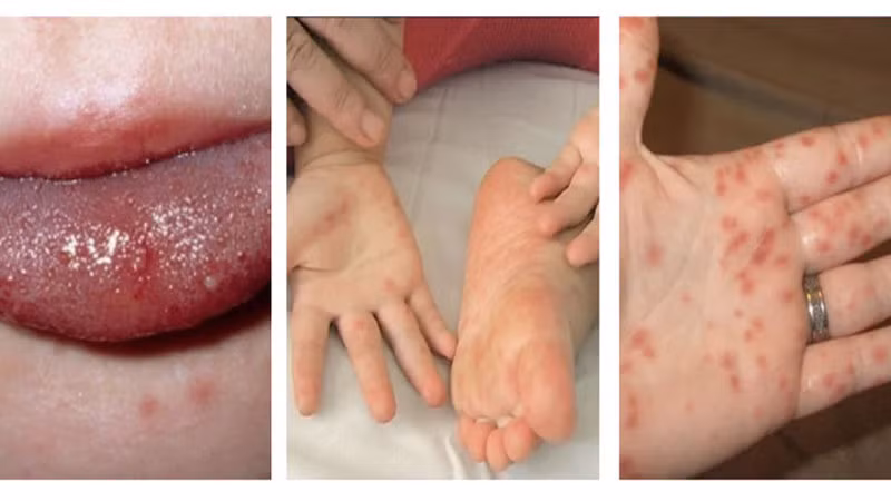 Những nốt ban do bệnh tay chân miệng có màu đỏ, sau đó tiến triển thành mụn nước vòm dày.(Ảnh minh họa)