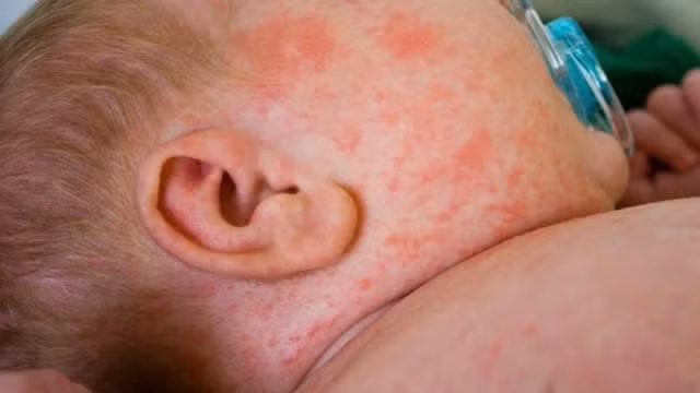 Triệu chứng dễ nhận biết của bệnh nhi mắc sởi là mẩn đỏ nổi khắp người