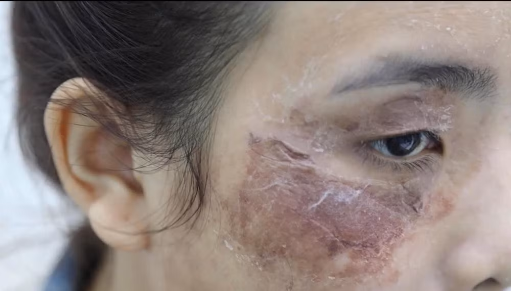 Một trường hợp bệnh nhân khác cũng nhập viện sau peel da và được điều trị tại Bệnh viện da liễu Thành phố.