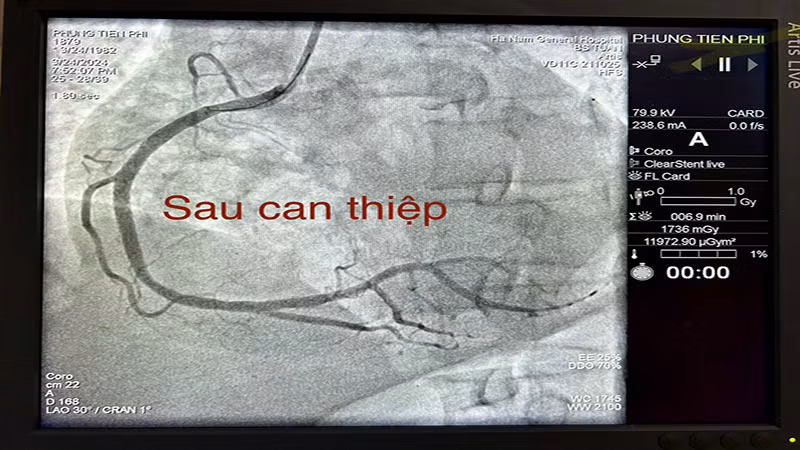 Hình ảnh động mạch vành của bệnh nhân Phùng Tiến Phi sau khi được can thiệp. (Ảnh: Bệnh viện Đa khoa tỉnh Hà Nam cung cấp)