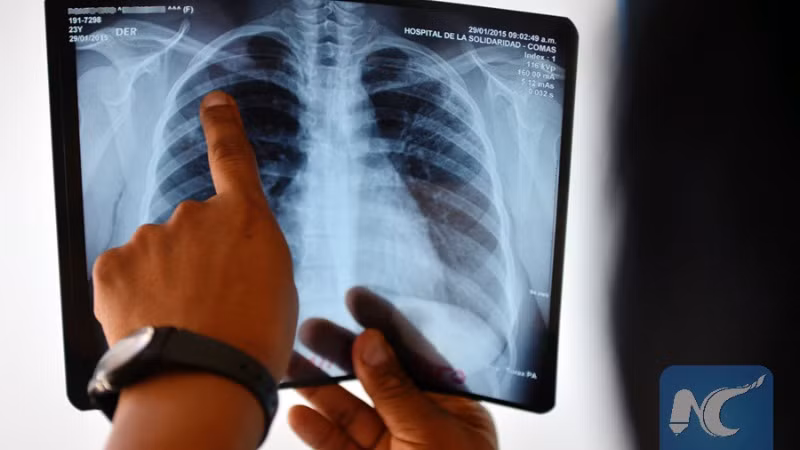 Phổi bệnh nhân nhiễm lao. (Ảnh tư liệu Tân Hoa xã)