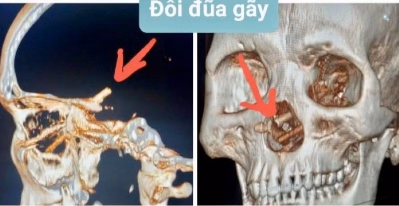 Hình ảnh chụp CT Scanner sọ não phát hiện đôi đũa trong mũi bệnh nhân. (Ảnh: Bệnh viện cung cấp) Hình ảnh chụp CT Scanner sọ não phát hiện đôi đũa trong mũi bệnh nhân. (Ảnh: Bệnh viện cung cấp)