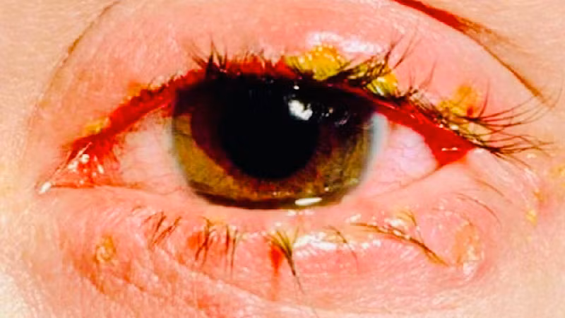 Bệnh đau mắt đỏ không được điều trị đúng cách dễ gây biến chứng, ảnh hưởng đến thị lực người bệnh.