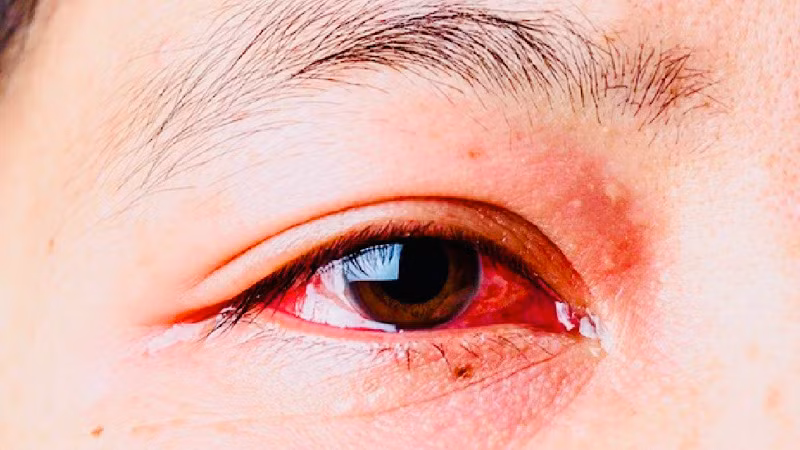 Bệnh đau mắt đỏ đang có nguy cơ bùng phát trên địa bàn thành phố Hải Phòng nếu không được phòng tránh tốt.