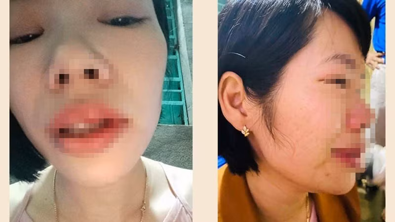 Cô giáo Vũ Thị Kim Q bị phụ huynh học sinh đến tận nhà riêng hành hung.