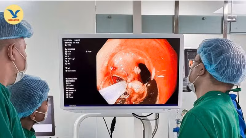 Nội soi cắt tách dưới niêm mạc (ESD) là kỹ thuật hiện đại hàng đầu thế giới trong điều trị ung thư sớm đường tiêu hóa.