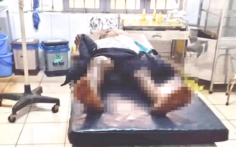 Cháu Y.N.N bị bỏng 2 chân khi được đưa vào Trung tâm Y tế huyện Ea H’leo khám, điều trị.