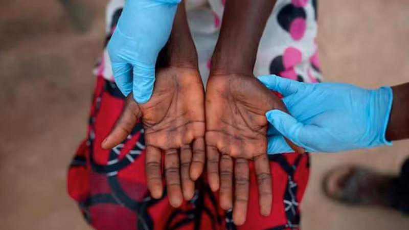 Bàn tay của bệnh nhân mắc đậu mùa khỉ. (Nguồn: apa)