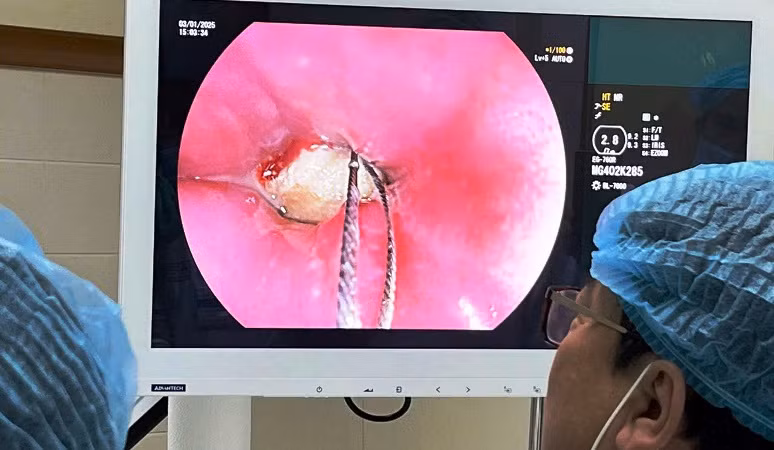 Ê-kíp tiến hành mổ nội soi để gắp dị vật trong thực quản của bệnh nhân V. (Ảnh: Bệnh viện Trung ương Huế cung cấp)