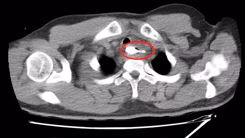 Dị vật là mẩu xương heo, có mấu nhọn, kích thước 30x41mm, nằm ở thực quản đoạn ngực, cách cung răng trên 20cm.