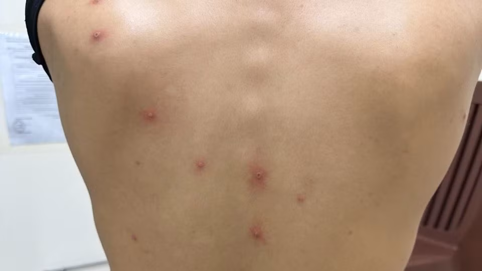 Bệnh nhân đến khám tại Bệnh viện Da liễu Thành phố Hồ Chí Minh và kết quả dương tính với vi rút Mpox.