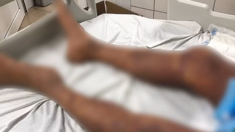 Một trường hợp toàn thân tím đen vì mắc liên cầu lợn. (Ảnh: Vietnam+)