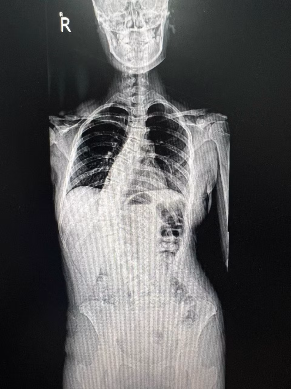 Hình ảnh gù vẹo cột sống ở trẻ em