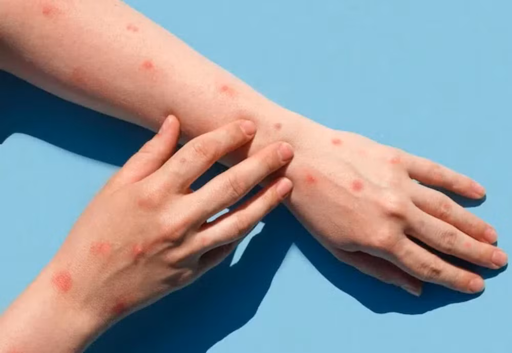 Ghi nhận ca bệnh đậu mùa khỉ đầu tiên ở Long An. (Ảnh minh họa)