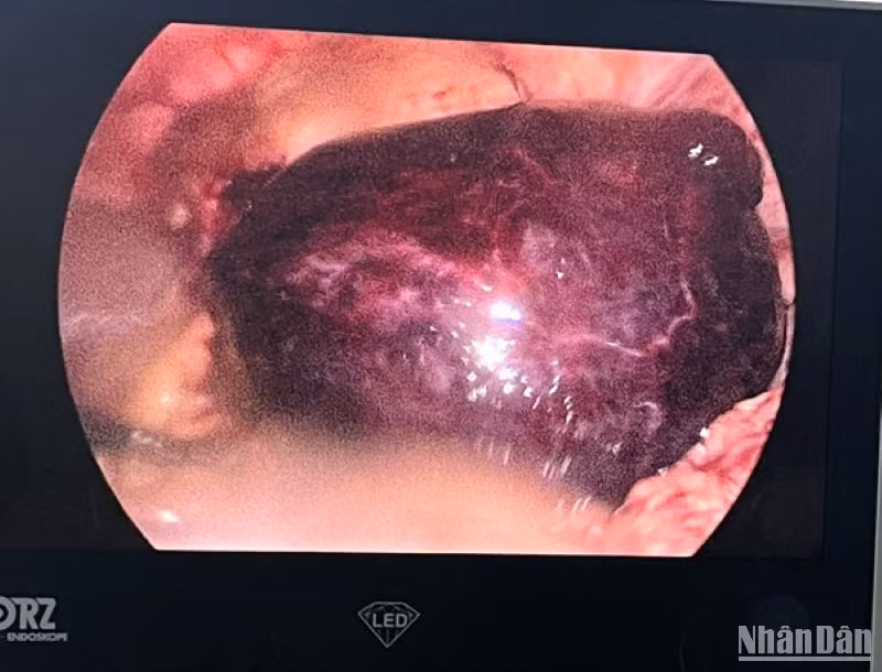 Hình ảnh u buồng trứng trái bị xoắn đã hoại tử khi nội soi ổ bụng.