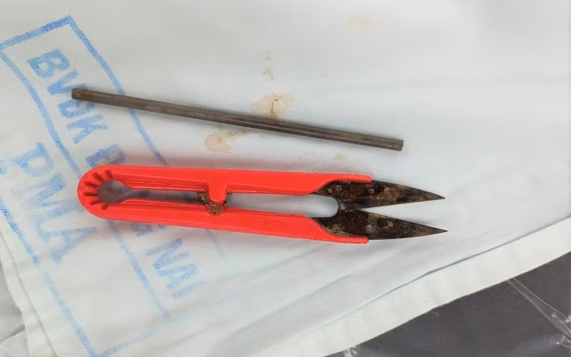 Thanh sắt và chiếc kéo cắt chỉ được lấy ra khỏi dạ dày bệnh nhân.